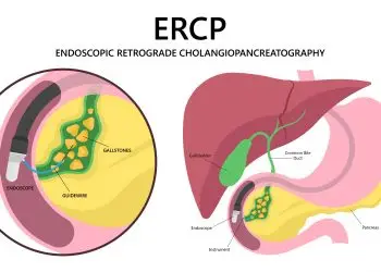 New Sedation Findings: ERCP for Bile and Pancreatic Ducts