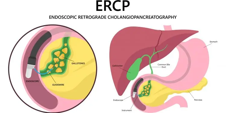 New Sedation Findings: ERCP for Bile and Pancreatic Ducts