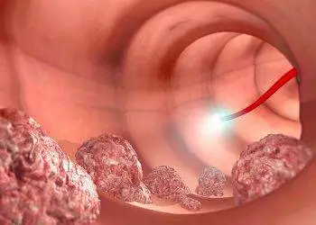 FDA Grants Clearance for Imaging Technology That Measures Colonic Lesions