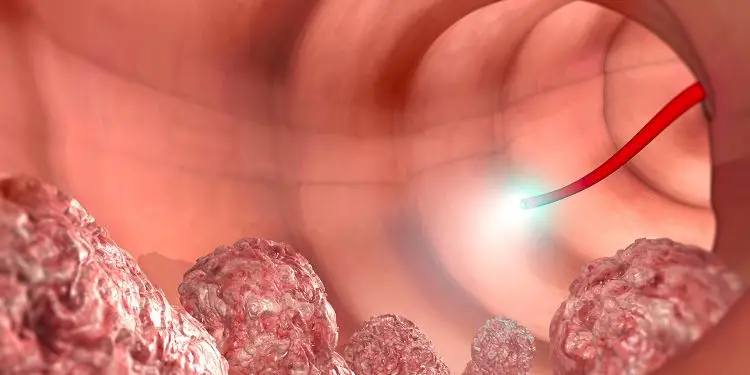 FDA Grants Clearance for Imaging Technology That Measures Colonic Lesions