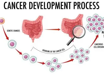 Is Abdominal Pain a Symptom of Colon Cancer?