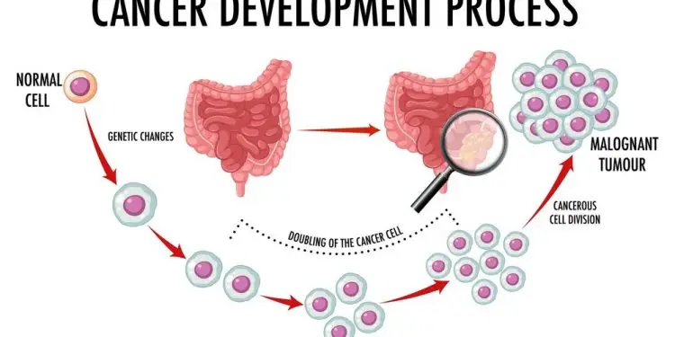 Is Abdominal Pain a Symptom of Colon Cancer?