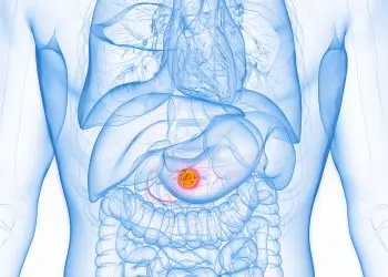 ESGE Releases Technical Guideline for Pancreatic Cyst Diagnosis