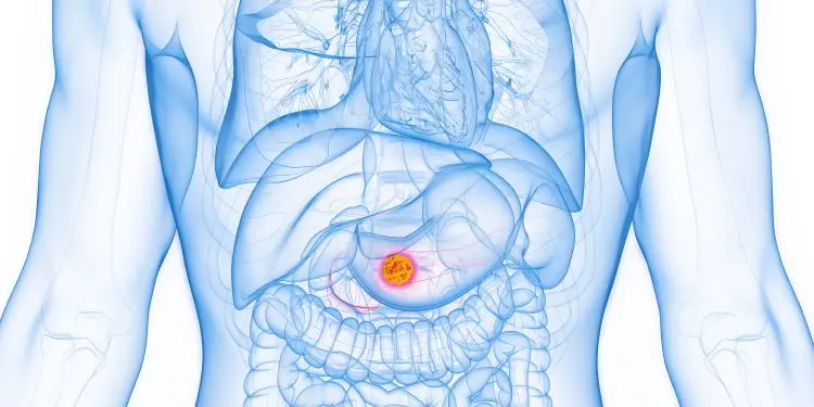 ESGE Releases Technical Guideline for Pancreatic Cyst Diagnosis