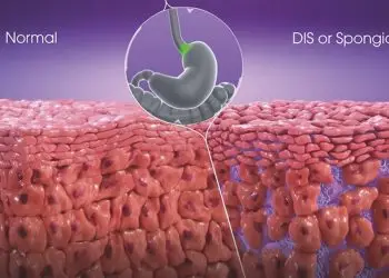 Mucosal Integrity Testing for GERD & EoE