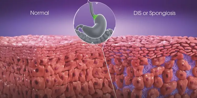 Mucosal Integrity Testing for GERD & EoE