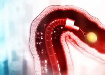 Polypectomy During Insertion