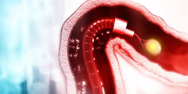 Polypectomy During Insertion